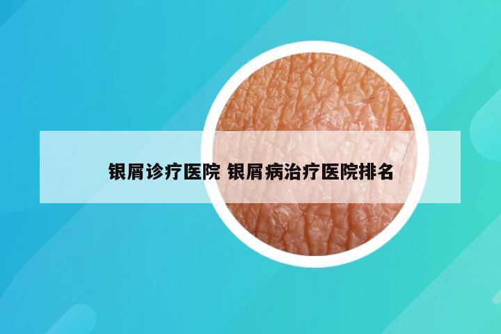 银屑诊疗医院 银屑病治疗医院排名