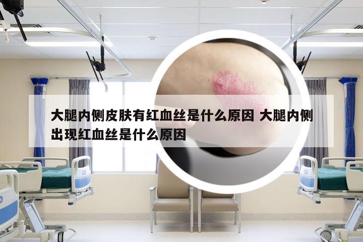 大腿内侧皮肤有红血丝是什么原因 大腿内侧出现红血丝是什么原因