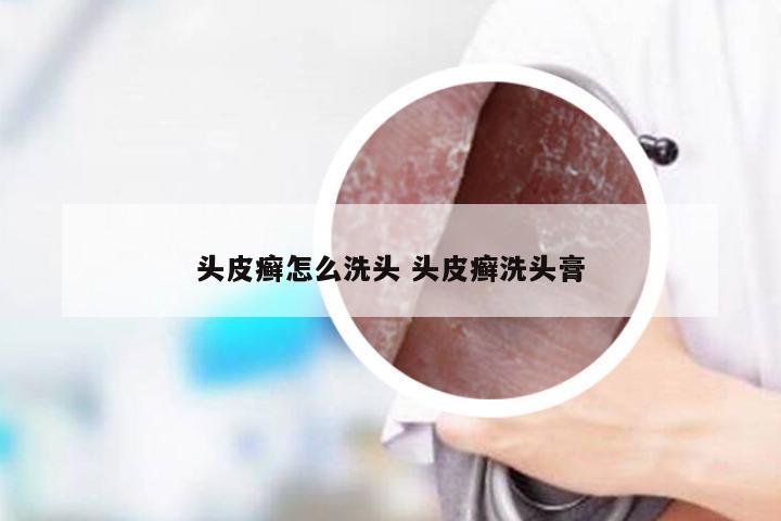 头皮癣怎么洗头 头皮癣洗头膏