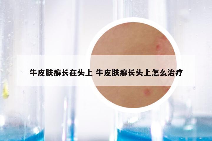 牛皮肤癣长在头上 牛皮肤癣长头上怎么治疗
