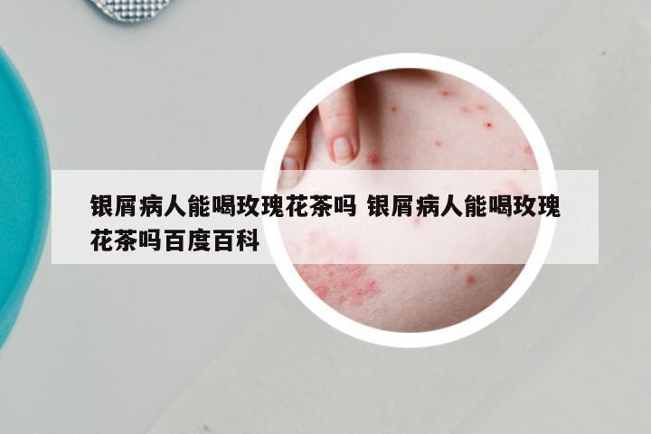 银屑病人能喝玫瑰花茶吗 银屑病人能喝玫瑰花茶吗百度百科