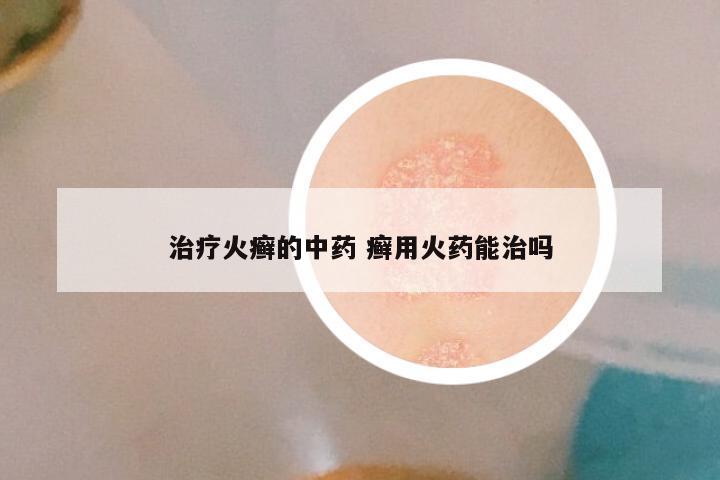 治疗火癣的中药 癣用火药能治吗