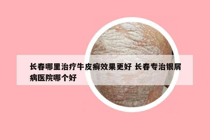 长春哪里治疗牛皮癣效果更好 长春专治银屑病医院哪个好