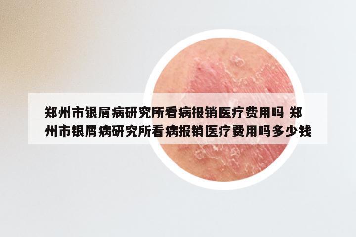 郑州市银屑病研究所看病报销医疗费用吗 郑州市银屑病研究所看病报销医疗费用吗多少钱