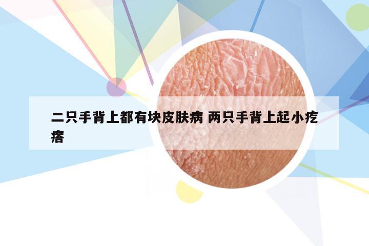 二只手背上都有块皮肤病 两只手背上起小疙瘩