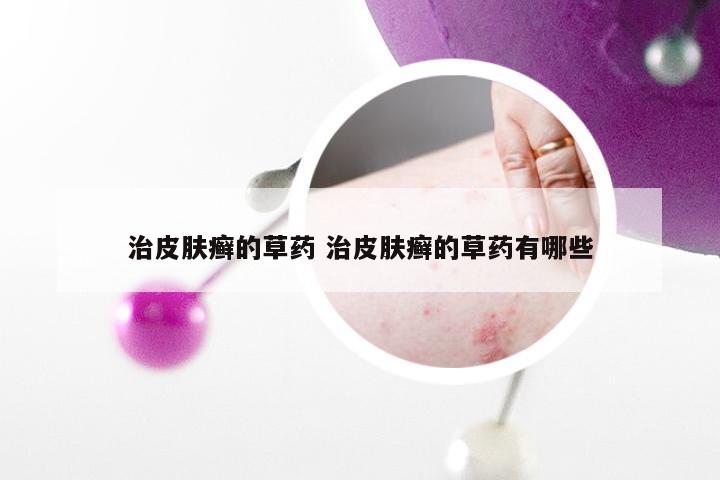 治皮肤癣的草药 治皮肤癣的草药有哪些