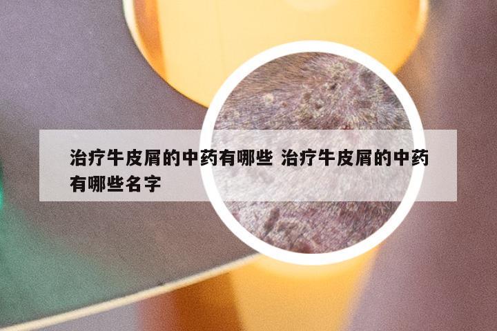 治疗牛皮屑的中药有哪些 治疗牛皮屑的中药有哪些名字