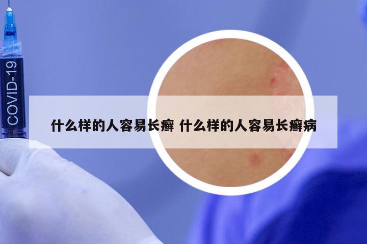 什么样的人容易长癣 什么样的人容易长癣病
