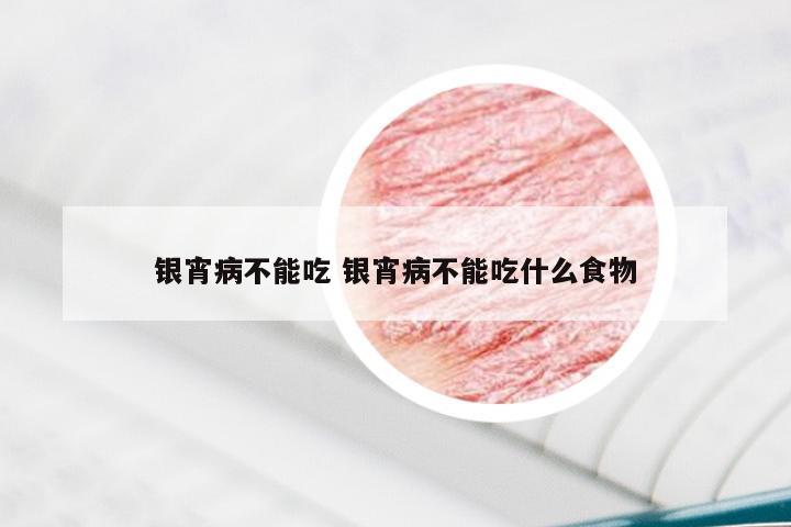 银宵病不能吃 银宵病不能吃什么食物