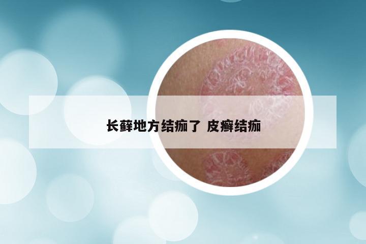 长藓地方结痂了 皮癣结痂