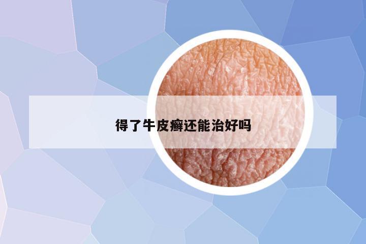 得了牛皮癣还能治好吗