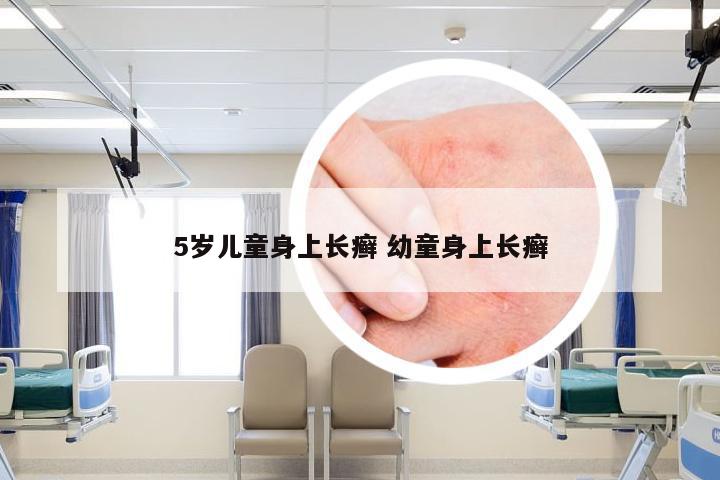 5岁儿童身上长癣 幼童身上长癣