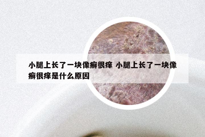 小腿上长了一块像癣很痒 小腿上长了一块像癣很痒是什么原因
