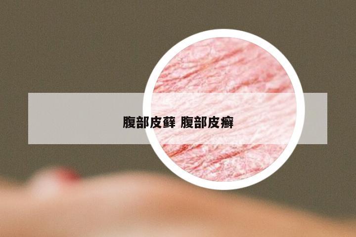 腹部皮藓 腹部皮癣