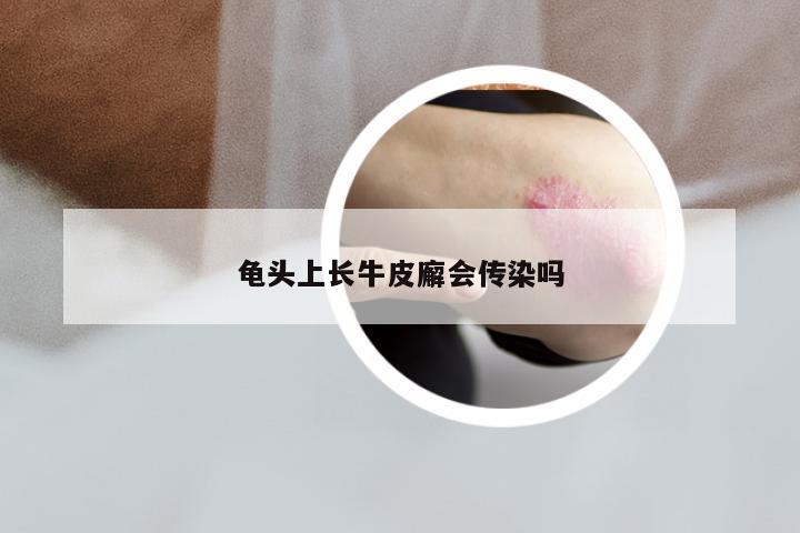 龟头上长牛皮廨会传染吗