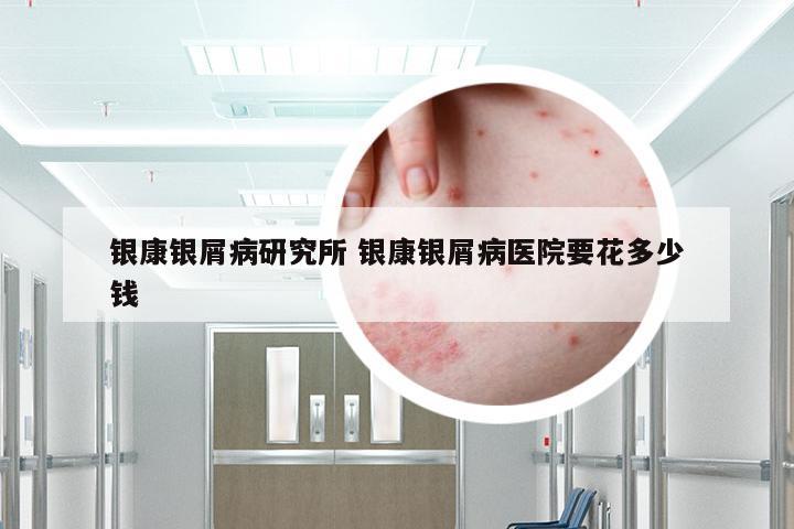 银康银屑病研究所 银康银屑病医院要花多少钱
