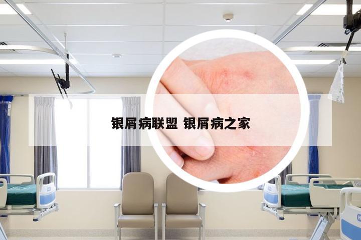 银屑病联盟 银屑病之家