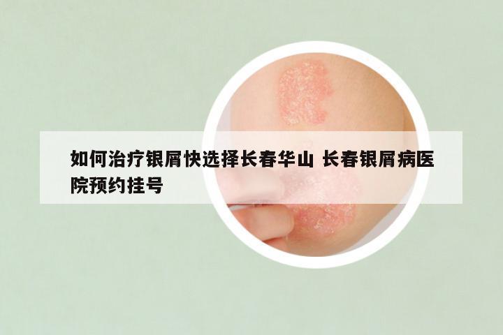 如何治疗银屑快选择长春华山 长春银屑病医院预约挂号