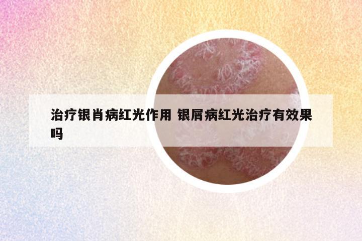 治疗银肖病红光作用 银屑病红光治疗有效果吗