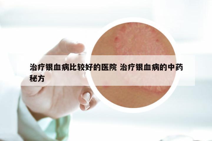 治疗银血病比较好的医院 治疗银血病的中药秘方