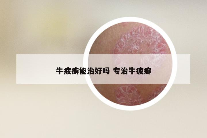 牛疲癣能治好吗 专治牛疲癣