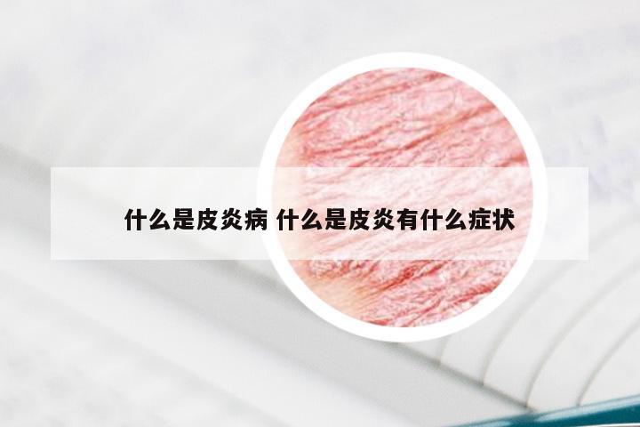 什么是皮炎病 什么是皮炎有什么症状