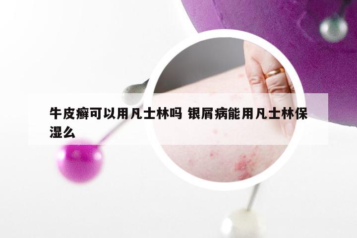 牛皮癣可以用凡士林吗 银屑病能用凡士林保湿么