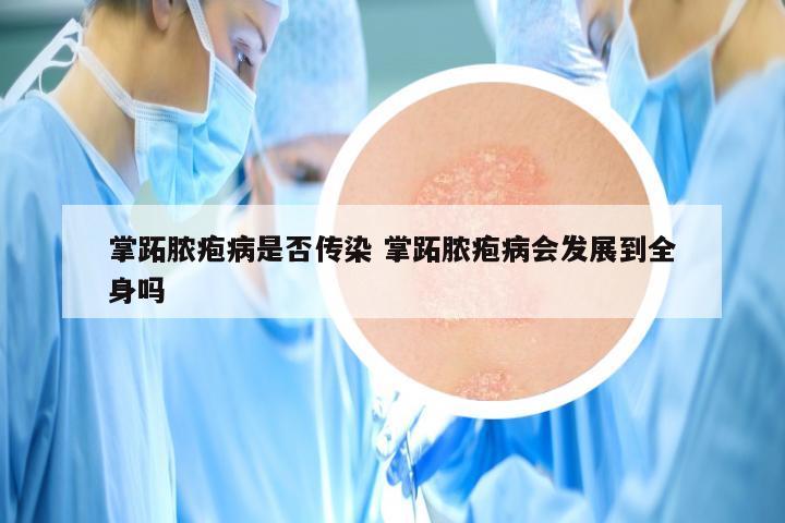掌跖脓疱病是否传染 掌跖脓疱病会发展到全身吗