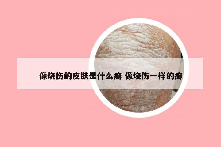 像烧伤的皮肤是什么癣 像烧伤一样的癣