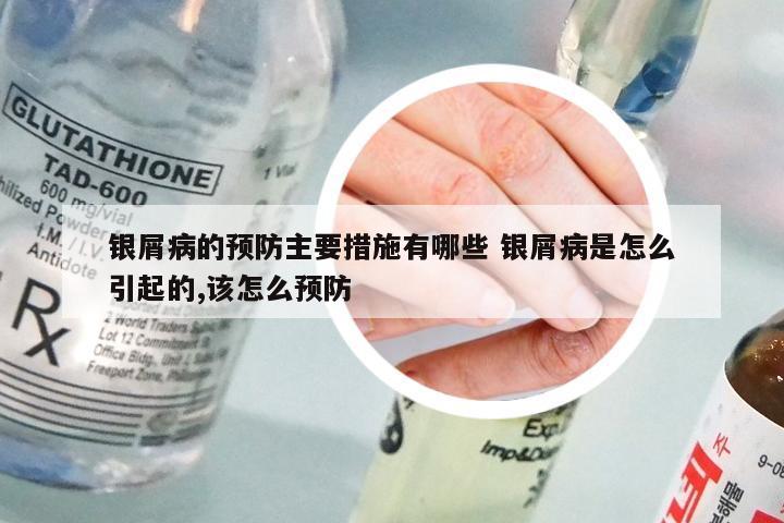 银屑病的预防主要措施有哪些 银屑病是怎么引起的,该怎么预防