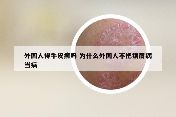 外国人得牛皮癣吗 为什么外国人不把银屑病当病