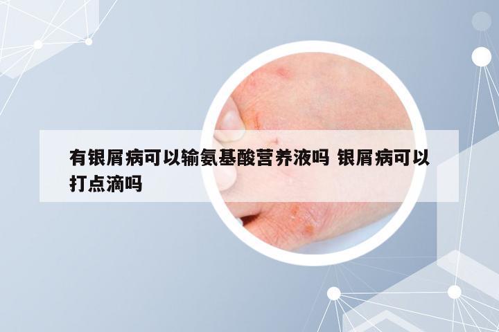 有银屑病可以输氨基酸营养液吗 银屑病可以打点滴吗