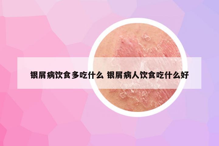 银屑病饮食多吃什么 银屑病人饮食吃什么好