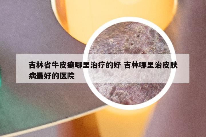 吉林省牛皮癣哪里治疗的好 吉林哪里治皮肤病最好的医院