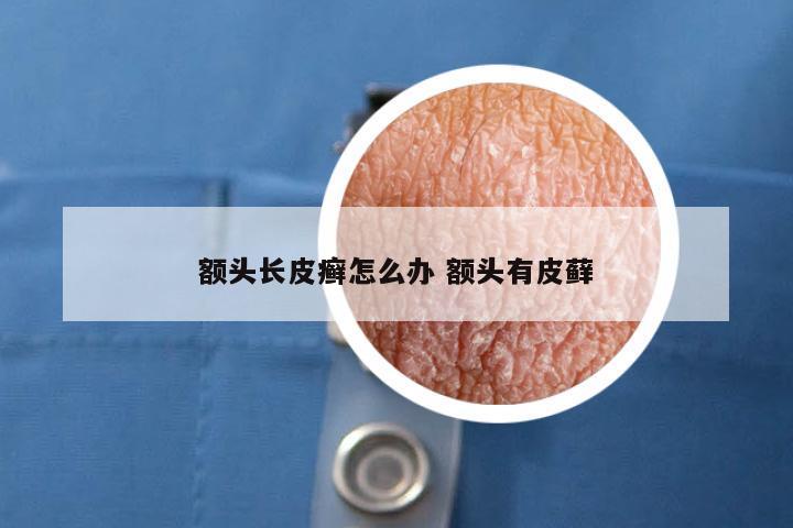 额头长皮癣怎么办 额头有皮藓