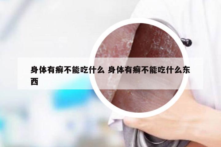 身体有癣不能吃什么 身体有癣不能吃什么东西