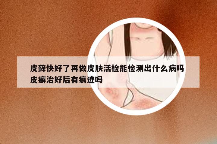 皮藓快好了再做皮肤活检能检测出什么病吗 皮癣治好后有痕迹吗