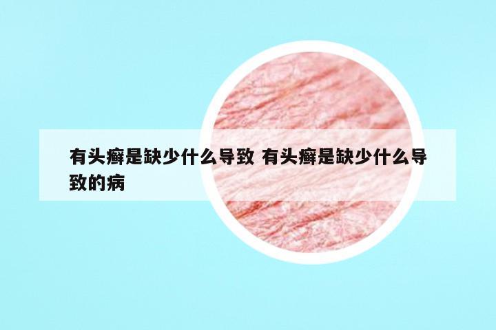 有头癣是缺少什么导致 有头癣是缺少什么导致的病