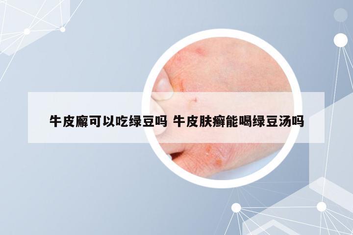 牛皮廨可以吃绿豆吗 牛皮肤癣能喝绿豆汤吗