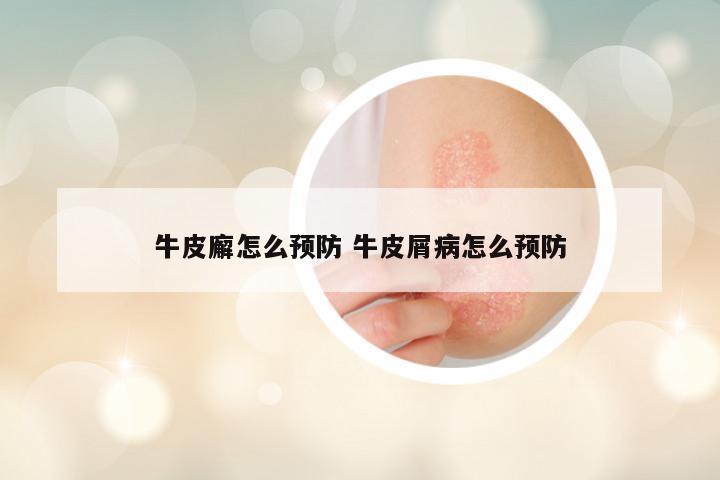 牛皮廨怎么预防 牛皮屑病怎么预防