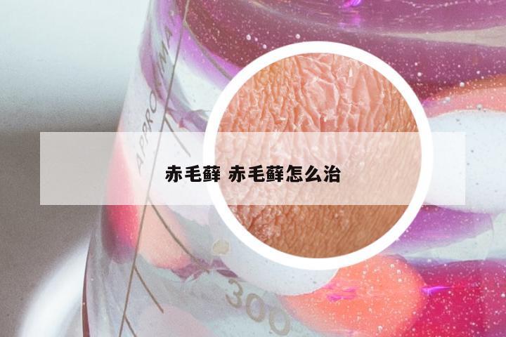 赤毛藓 赤毛藓怎么治