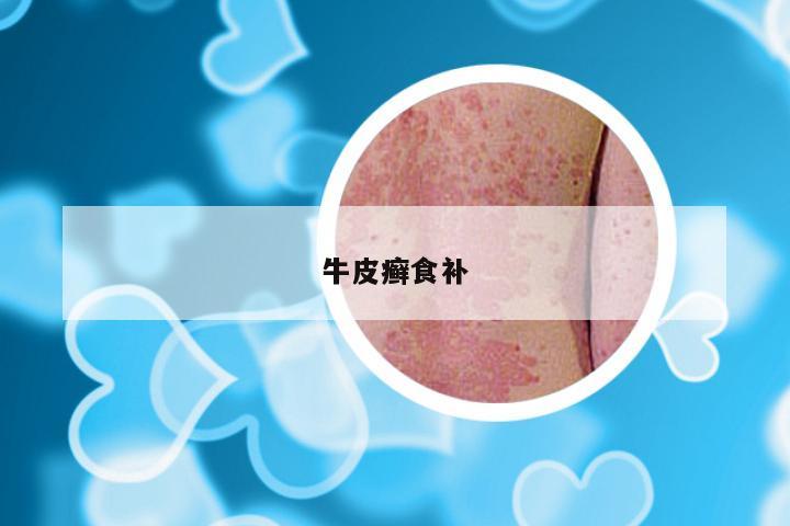 牛皮癣食补