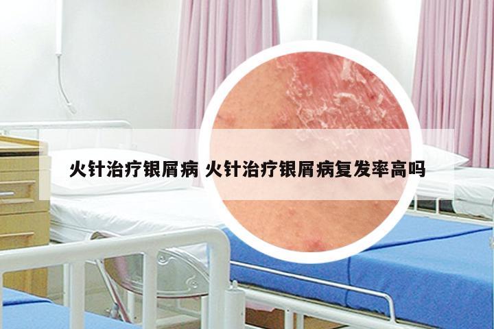 火针治疗银屑病 火针治疗银屑病复发率高吗