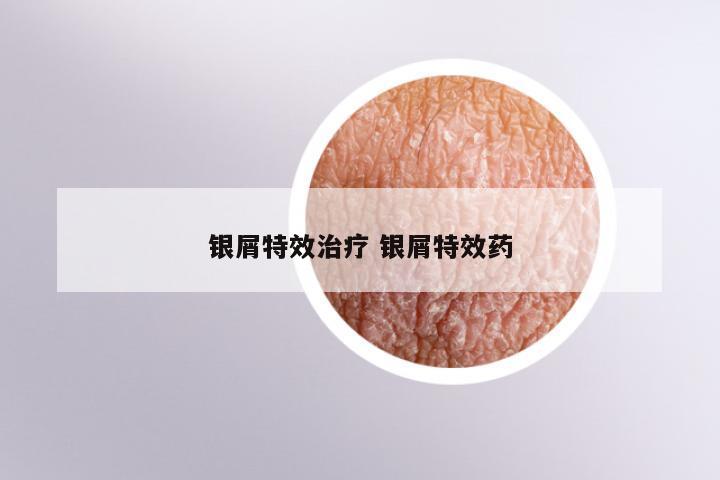 银屑特效治疗 银屑特效药