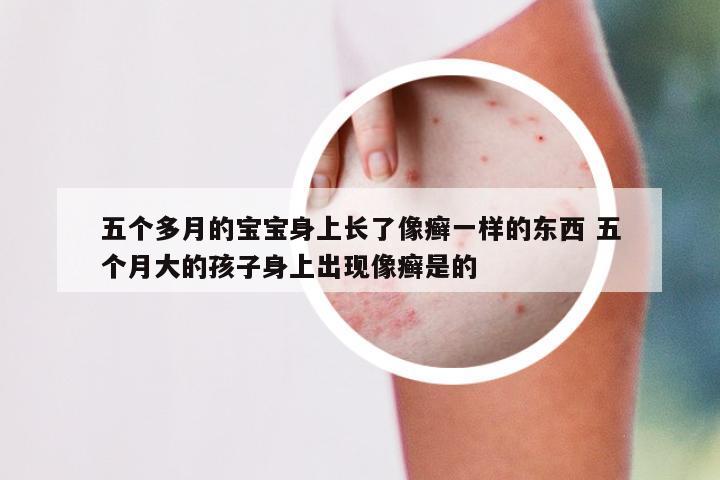 五个多月的宝宝身上长了像癣一样的东西 五个月大的孩子身上出现像癣是的