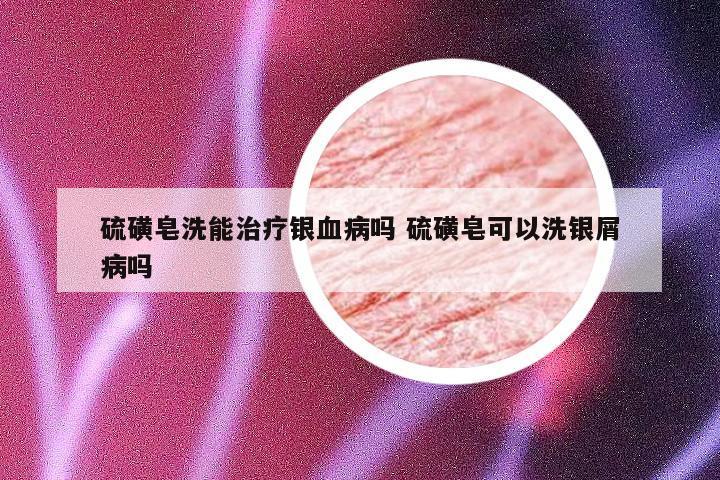 硫磺皂洗能治疗银血病吗 硫磺皂可以洗银屑病吗