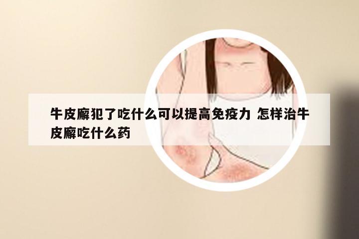 牛皮廨犯了吃什么可以提高免疫力 怎样治牛皮廨吃什么药