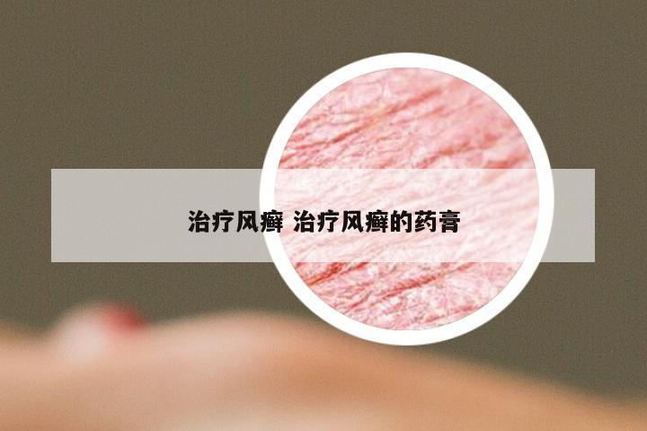 治疗风癣 治疗风癣的药膏