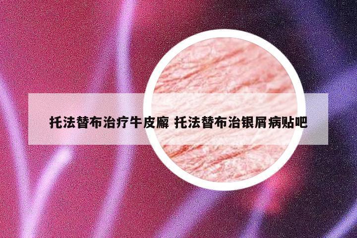 托法替布治疗牛皮廨 托法替布治银屑病贴吧