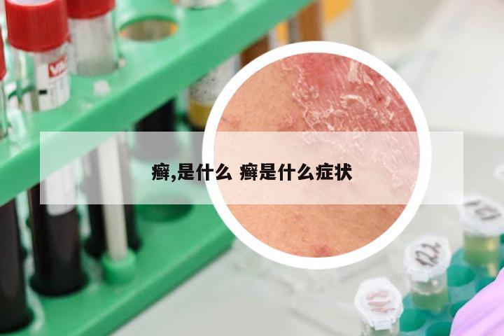 癣,是什么 癣是什么症状